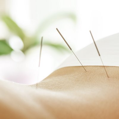 Akupunktur Rücken